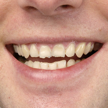 Veneers – Zahn-Verblendschalen – unschöne Zahnkante – vorher