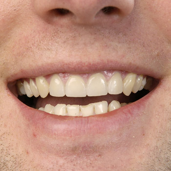 Veneers – Zahn-Verblendschalen – Ergebnis ist eine saubere Zahnkante – nachher